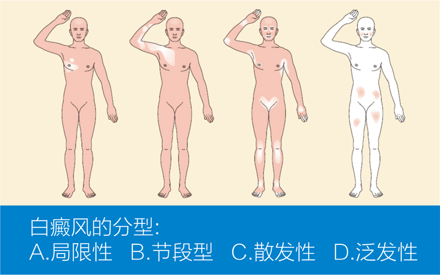 王宏偉教授專欄|白癜風(fēng)相關(guān)知識科普(圖2)